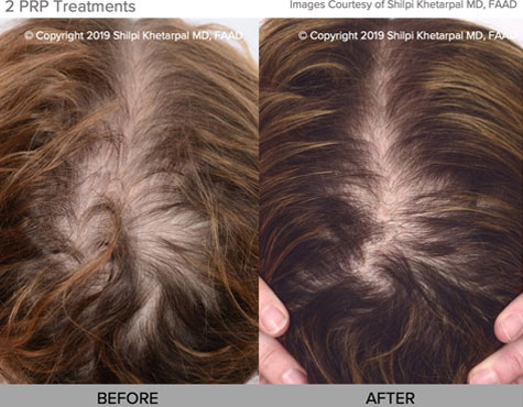 before and after photo of male hair loss restoration