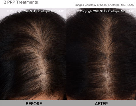 female hair loss treatment photo