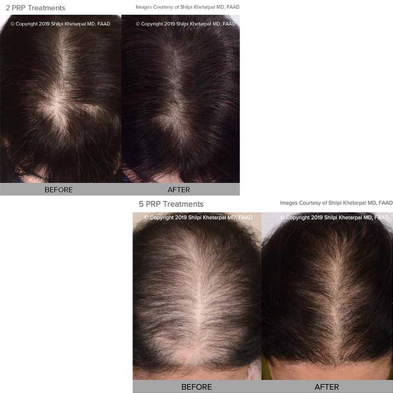 hair loss treatment before and after photo