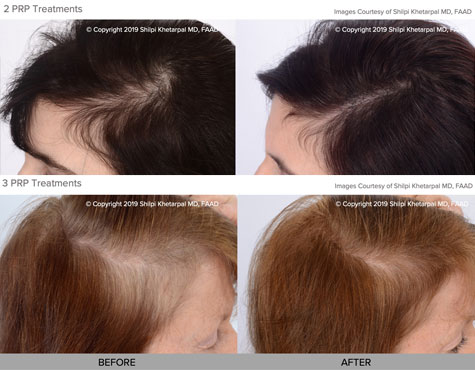 hair loss treatment before and after photo